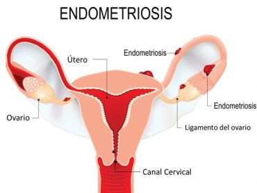 Botika 65 | Endometriosis